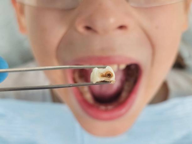 Best Emergency Treatment for Dental Infections or Abscesses in Seagraves, TX
